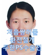 [두한ps]- #쌍꺼풀 처음수술 #완전절개 #답답해보이는 눈매교정 관련 이미지 1