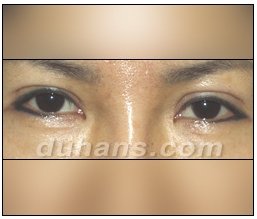 Candidates for Double Eyelid Revision Surgery: Unattractive Double Eyelids, Beautiful Double Eyelids image 23