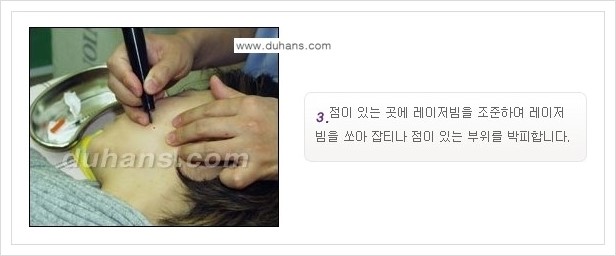[두한성형외과 경쟁력 레이저시술] - [이산화탄소 점제거 안내] 관련 이미지 5