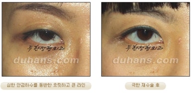 [Special Double Eyelid Revision Surgery at Duhan Plastic Surgery] - [Restorative Surgery for Damaged Double Eyelid Eye Shape] image 23