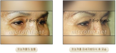 [Doohan Plastic Surgery Autologous Fat Grafting] - [Sunken Eye Fat Grafting] image 33