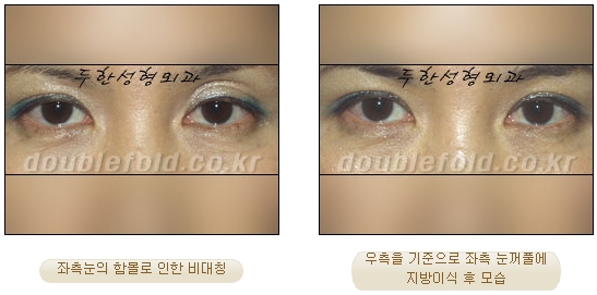 [Eye Reoperation Duhan Plastic Surgery] - [Guide to Double Eyelid Revision Surgery] image 59