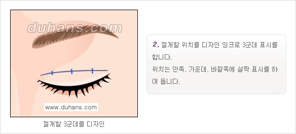 [두한성형외과 경쟁력 눈성형]- [최소 부기로 일상의로의 복귀가 가능한 아름다운 퀵쌍꺼풀(부분절개법) 수술] 관련 이미지 2