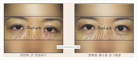 [두한성형외과 경쟁력 눈성형] - [안검하수와 몽고주름에 대한 자주하는 질문과 답변] 관련 이미지 9