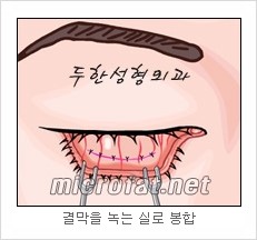 두한성형외과 눈밑성형 - 눈밑지방제거, 눈밑주름, 눈밑지방재배치 관련 이미지 8