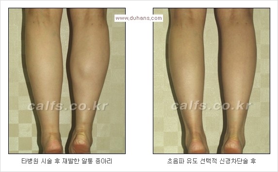 [두한성형외과 Dr. 컬럼] - [종아리 근육퇴축술로 가장 선호하는 비절개 초음파 유도 선택적 신경차단술] 관련 이미지 23