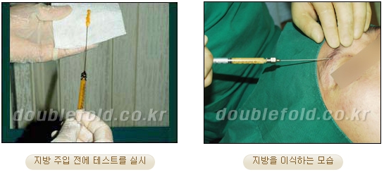 쌍커풀수술 두한성형외과 - 쌍꺼풀라인낮추기 관련 이미지 16