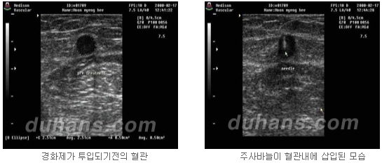 [두한성형외과 정맥류] - [하지정맥류, 정맥확장증, 혈관확장증] 관련 이미지 11