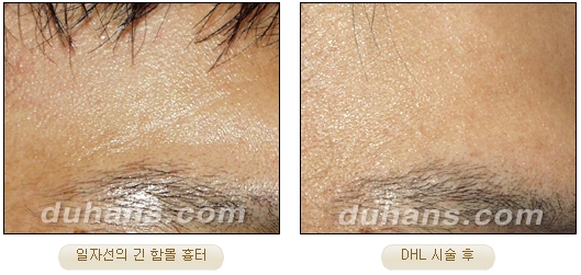 [DuHan Plastic Surgery Scar] - [DHL Simple Scar Treatment] image 13