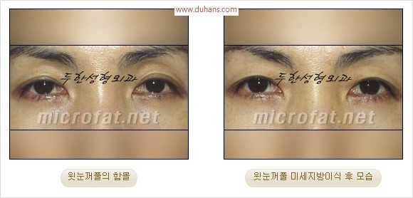 [두한성형외과 경쟁력 눈성형 리더] - [윗눈꺼풀 함몰( #꺼진눈꺼풀) 미세지방이식과 상안검성형]#꺼진눈성형 , #눈위함몰 관련 이미지 25