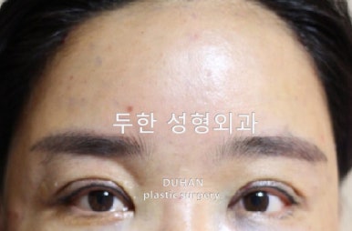 [Duhan Plastic Surgery Forehead Surgery] - [Forehead Fat Grafting for Forehead Surgery] image 19