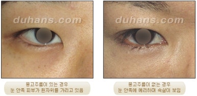 [Duhan Plastic Surgery Double Eyelid Revision Surgery] - [Partial Incision Method and Epicanthoplasty] image 58