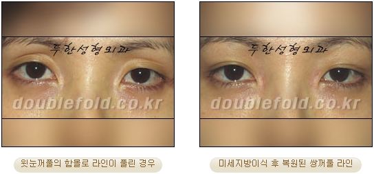 [Eye Reoperation Duhan Plastic Surgery] - [Guide to Double Eyelid Revision Surgery] image 62