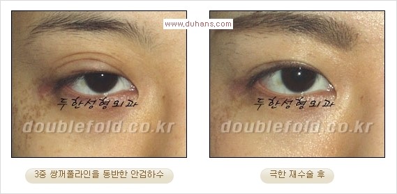 [두한성형외과 경쟁력 쌍꺼풀 재수술] - [피부 여유분이 부족해서 토안증이 발생한 경우 극한 재수술] 관련 이미지 8