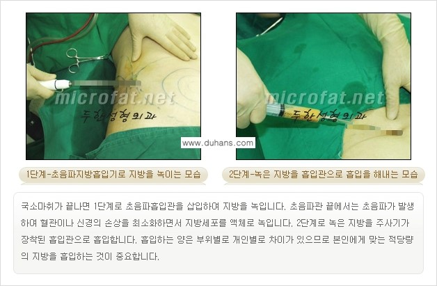 [두한성형외과 겨울엔 지방흡입 도전] - [간편한 복부지방흡입 1.] 관련 이미지 9