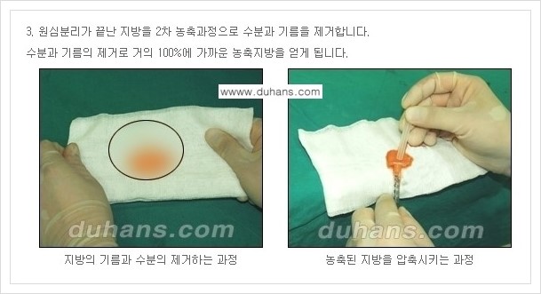 ​[두한성형외과 경쟁력 주름성형] - [주름교정을 위한 미세지방이식 안내 1.] 관련 이미지 9