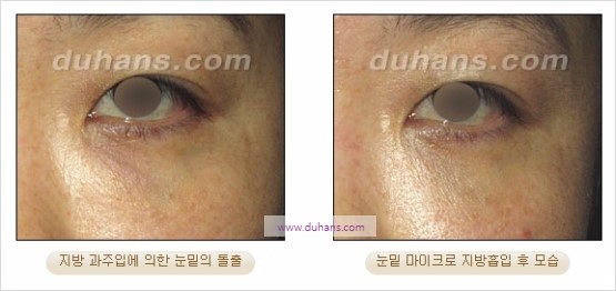 [두한성형외과 경쟁력 지방흡입] - [볼살, 턱선의 간편 지방흡입] 관련 이미지 35