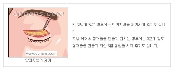 [두한성형외과 경쟁력 안검성형] - [상큼하고 환한 눈매의 완성 상안검 성형술 안내] 관련 이미지 5