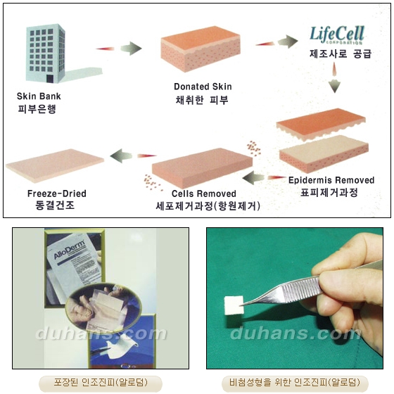 DuHan Plastic Surgery Revision Rhinoplasty - AlloDerm Nose Surgery, SureDerm Nose Surgery image 3
