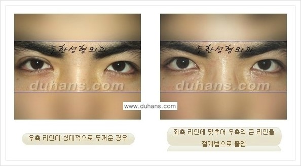 [두한성형외과 경쟁력 쌍꺼풀 재수술, 극한 재수술] - [비대칭(짝짝이) 쌍꺼풀 라인 교정 안내] 관련 이미지 7