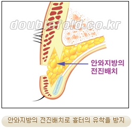 [두한성형외과 쌍커풀재수술] - [심한 소세지눈, 두줄따기, 쌍꺼풀 흉터] 관련 이미지 11