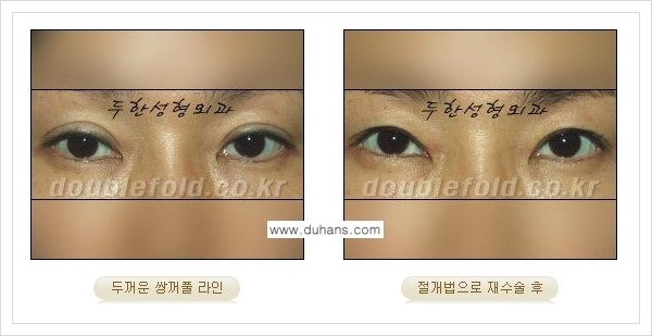 [두한성형외과 경쟁력 쌍꺼풀 재수술] - [두껍고 어색한 라인 교정하는 방법 안내 2.] 관련 이미지 9
