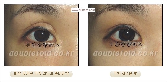 [두한성형외과 경쟁력 쌍꺼풀 재수술 스페셜] - [망가진 라인을 교정하는 극한 재수술] 관련 이미지 12
