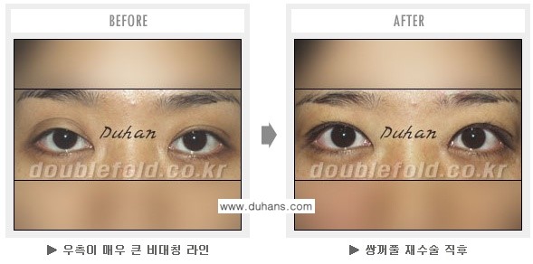 [두한성형외과 쌍꺼풀 재수술] - [과도한 앞트임이 되어있을 경우의 문제] 관련 이미지 7