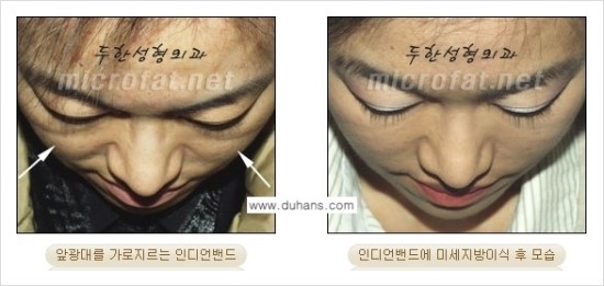 [두한성형외과 경쟁력 귀족성형] - [3차원 입체 미세지방이식 귀족수술 + 인디언밴드 교정] 관련 이미지 24