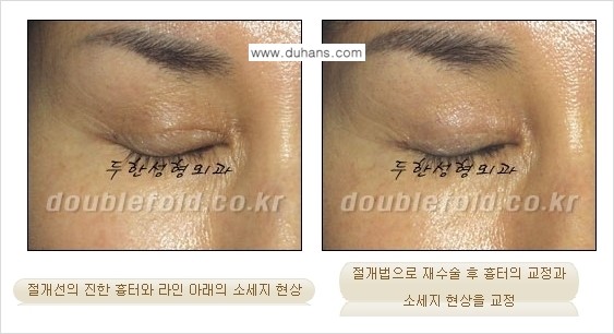 [두한성형외과 경쟁력 쌍꺼풀 재수술] - [흉터선이 진한 경우] 관련 이미지 4