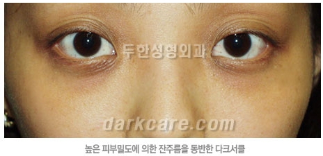 Duhan Plastic Surgery Dark Circle Improvement - What Causes Dark Circles? What Types of Dark Circles Are There? image 10