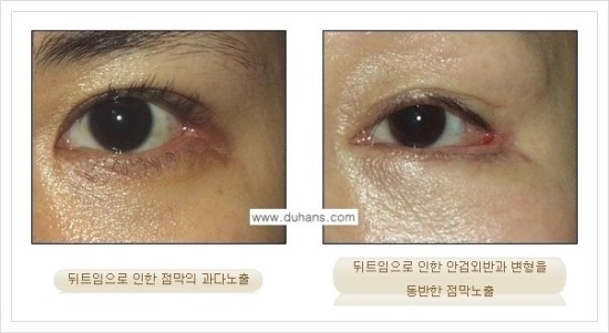 ​[두한성형외과 경쟁력 눈매성형] - [눈의 가로길이를 키우는 앞트임, 뒤트임 수술] 관련 이미지 29