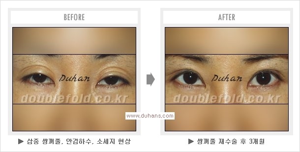 [두한성형외과 경쟁력 쌍꺼풀 재수술, 극한 눈재수술] - [두툼한 소세지 쌍꺼풀 라인 교정] 관련 이미지 10