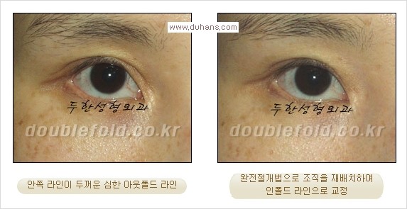 [두한성형외과 경쟁력 눈성형] - [두꺼운 아웃폴드 라인을 인폴드 라인으로 교정] 관련 이미지 11