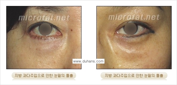 [두한성형외과 "미세지방이식"] - [지방이식 부작용 교정 정보 ①] 관련 이미지 5