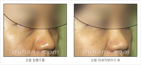 [두한성형외과 경쟁력 주름성형] - [세월의 흔적! 주름을 교정하는 여러 가지 교정 방법] 관련 이미지 19