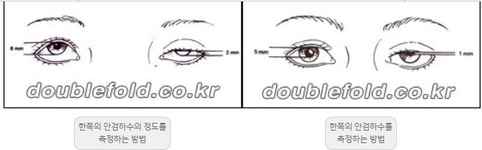 [Ptosis, Duhan Plastic Surgery] - [Sleepy-Looking Eyes, Ptosis Eye Correction] image 9