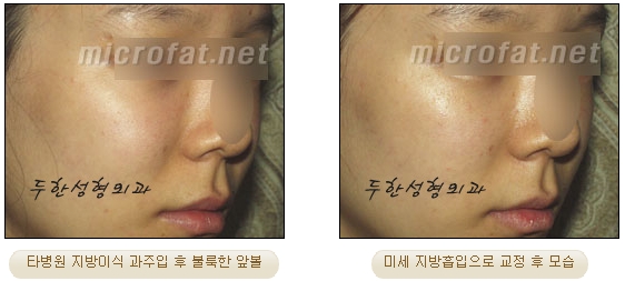 얼굴지방이식 두한성형외과 - 볼지방이식 관련 이미지 42