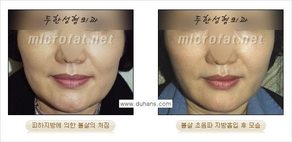 ​[두한성형외과 가을엔 지방흡입을] - [볼살, 눈밑, 턱선 초음파 미세지방흡입] 관련 이미지 12