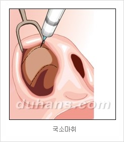 DuHan Plastic Surgery Revision Rhinoplasty - AlloDerm Nose Surgery, SureDerm Nose Surgery image 4