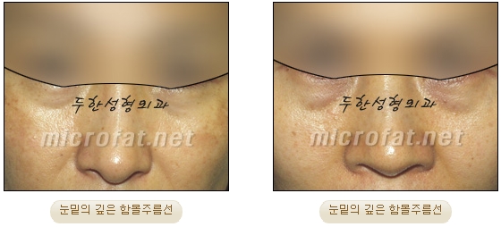[두한성형외과 지방이식] - [다크서클, 눈밑주름] 관련 이미지 6
