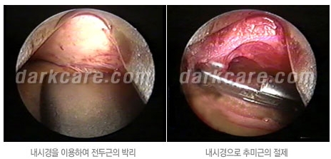 Duhan Plastic Surgery Combo Program - Dark Circles and Lifting image 22