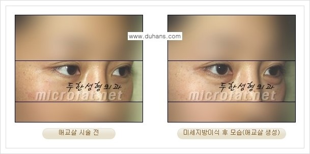 [두한성형외과 경쟁력 눈밑성형] - [눈밑 애교살 시술 안내 1.] 관련 이미지 7