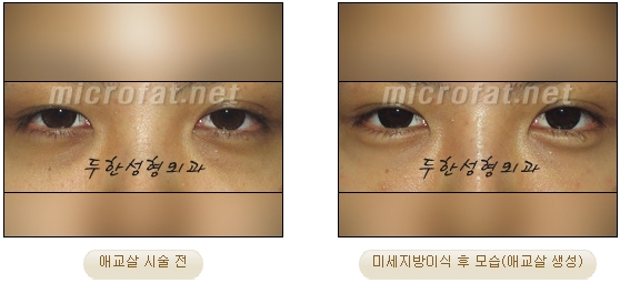 ​[두한성형외과 지방이식] - [애교살] 관련 이미지 16