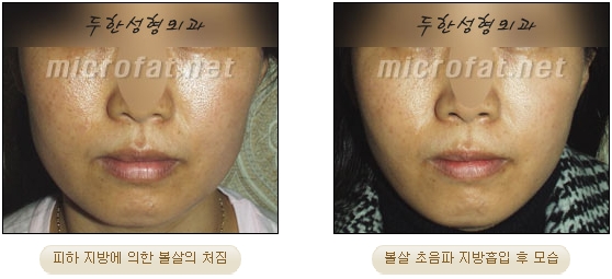 [Duhan Plastic Surgery Liposuction] - [Facial Liposuction] image 28