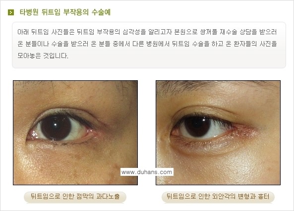 [두한성형외과 NO.1 눈성형] - [앞트임 복원, 뒤트임 복원] 관련 이미지 7