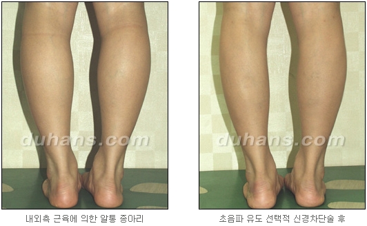 [Duhan Plastic Surgery Calf Reduction] - [How to Get Rid of Calf Muscle Bulges] image 28