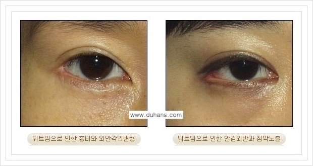 [두한성형외과 경쟁력 쌍꺼풀 재수술, 극한 눈재수술] - [뒤트임 부작용과 뒤트임 교정수술 방법 안내] 관련 이미지 9