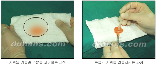 [두한성형외과 얼굴자가지방이식] - [귀족수술 입체 미세지방이식] 관련 이미지 9