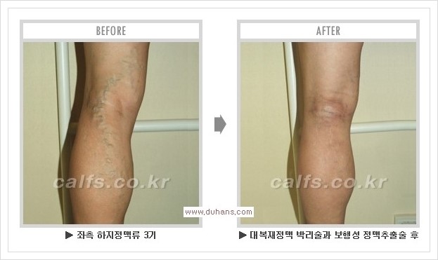 [두한성형외과 경쟁력 멀티종아리성형] - [종아리성형 방법별 전후 주의사항] 관련 이미지 38